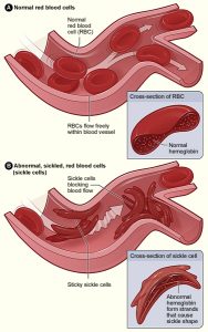 graphic showing difference between normal and sickled red blood cells