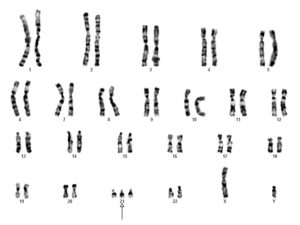 Karyotype of individual with Downs Syndrome