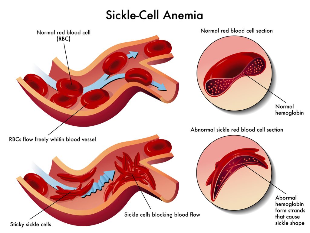diagram of sickle cell anemia