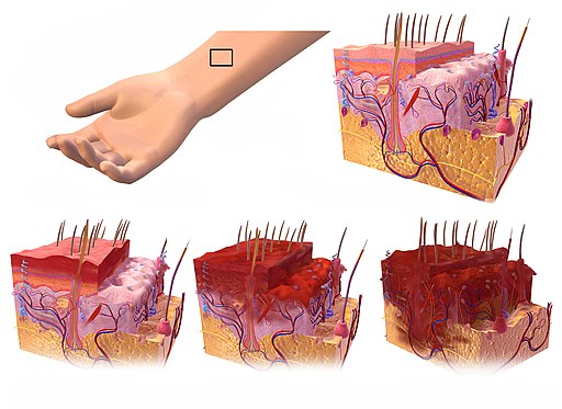 degrees of burns