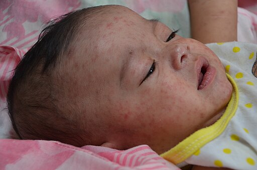 Infant with measles