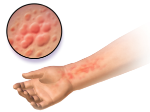 Skin hives or uriticaria