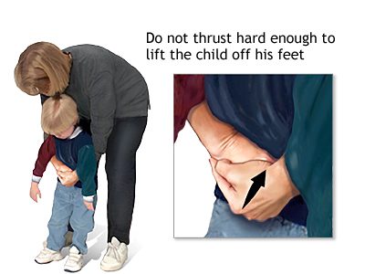 Heimlich maneuver position for child