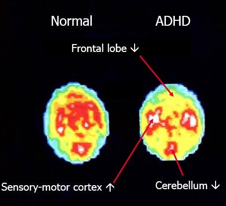 Normal and ADHD brain scans