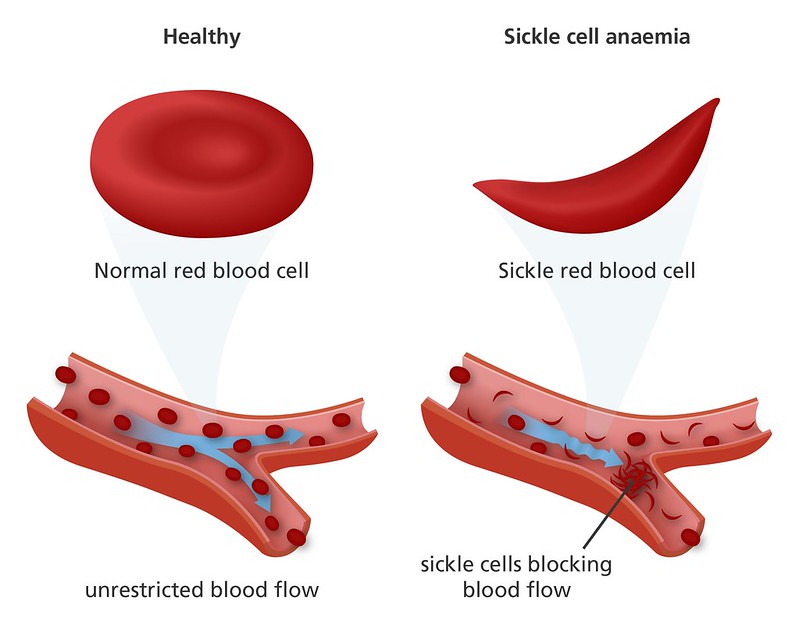 Normal red blood cell and sickle cell