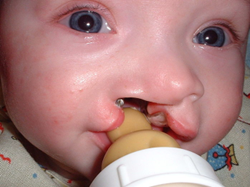 baby with cleft pallate