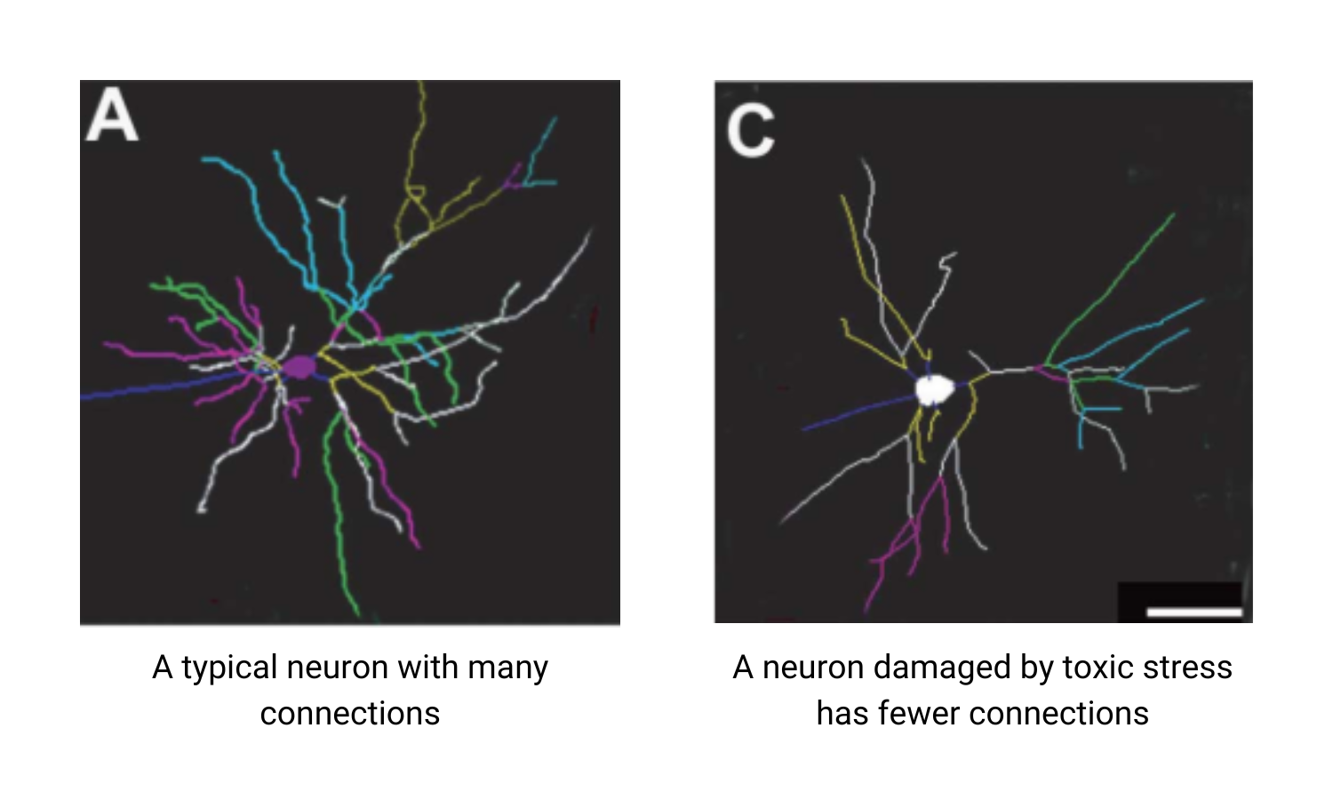 Comparison of the impact of toxic stress on neuron connections. The image on the left, labeled A, shows a typical neuron with many connections. The image on the right, labeled C, shows that a neuron damaged by toxic stress has fewer connections.