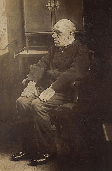 "Man_showing_the_characteristic_appearances_of_acromegaly_Wellcome_L0062529.jpg" by unknown author via Welcome Collection Gallery and is licensed under CC BY 4.0 Image showing a person with symptoms of Acromegaly