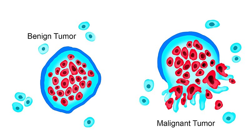 “Tumor_Types_MTK.jpg” by WolfpackBME is licensed under CC BY-SA 4.0 Illustration showing both benign and malignant tumors
