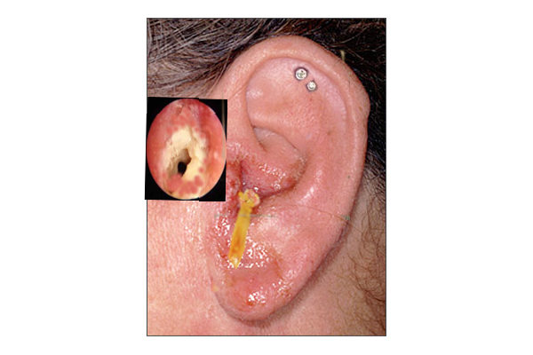 Image showing Otitis Externa