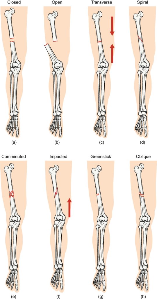 “612_Types_of_Fractures.jpg” by OpenStax College is licensed under CC BY 4.0 Illustration showing several types of fractures on a human leg
