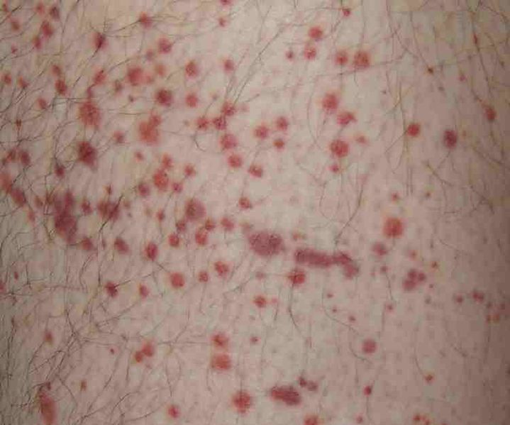 Photo showing petechiae and purpura on skin