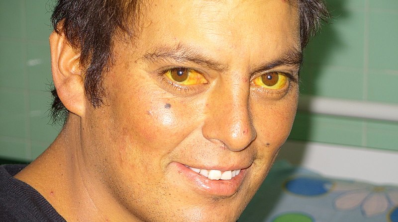 Image showing a patient with yellow sclera, indicative of jaundice