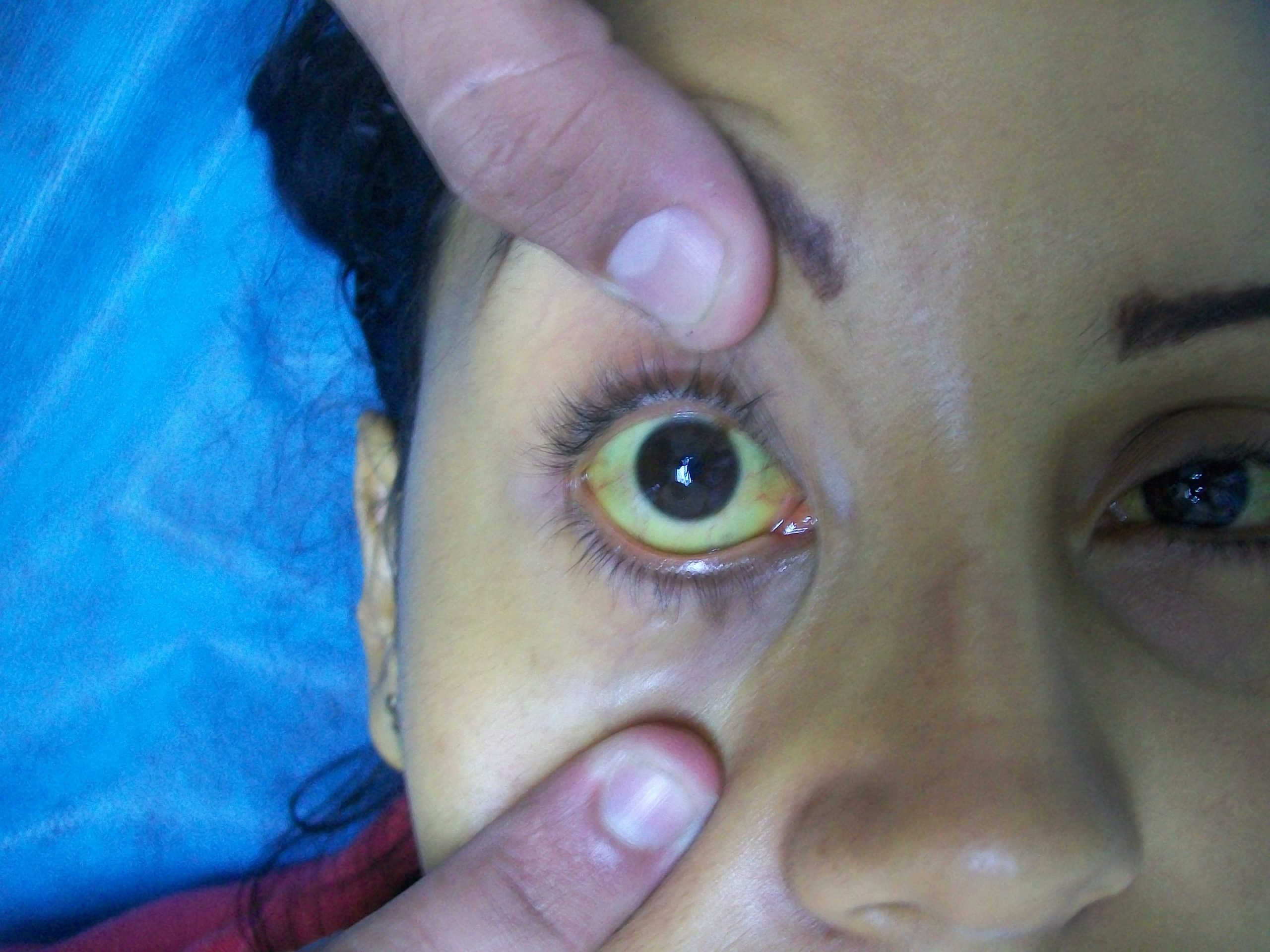 Photo showing yellow coloring or eye, indicative or jaundice