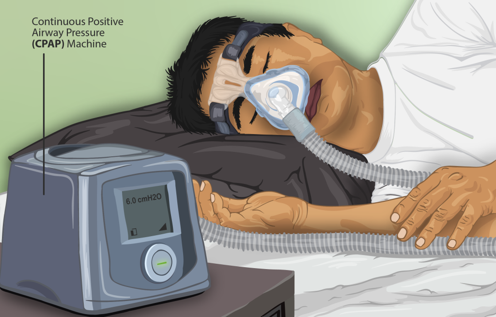 “Depiction of a sleep apnea patient using a CPAP machine” by https://www.myupchar.com/en is licensed under CC BY 4.0 Illustration of person asleep on their side, while using a C-pap machine