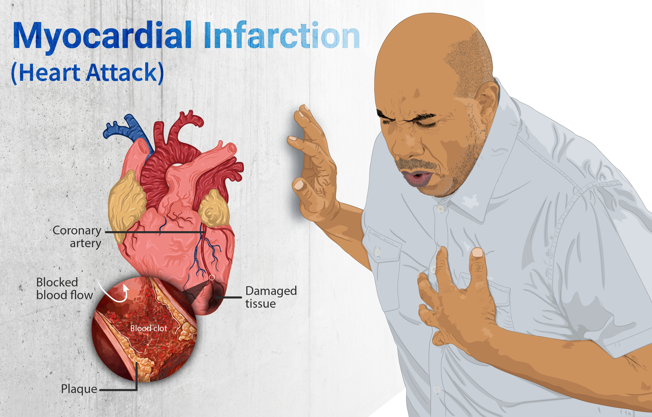 "Depiction_of_a_person_suffering_from_a_heart_attack_(Myocardial_Infarction).png" by https://www.myupchar.com/en is licensed under CC BY-SA 4.0 Illustration showing the effects of a Myocardial Infarction