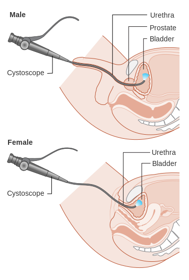 “Diagram_showing_a_cystoscopy_for_a_man_and_a_woman_CRUK_064.svg” by Cancer Research UK is licensed under CC BY-SA 4.0 Illustration showing cystoscopy on both a male and a female