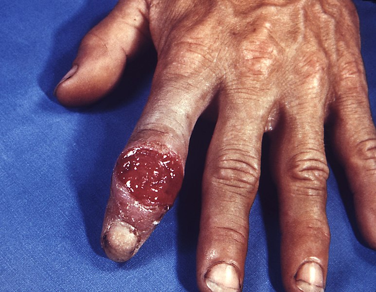 "Extragenital_syphilitic_chancre_of_the_left_index_finger_PHIL_4147_lores.jpg" by Centers for Disease Control and Prevention is licensed in the Public Domain. Image showing a syphilis chancre on the index finger