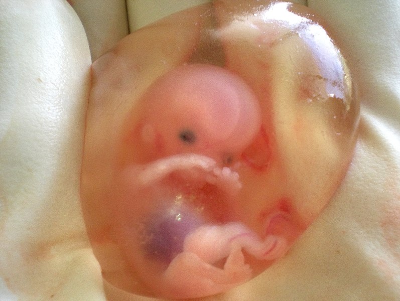 "Human_fetus_10_weeks_with_amniotic_sac_-_therapeutic_abortion.jpg" by suparna sinha is licensed under CC BY-SA 2.0 Image showing a 10 week old human fetus