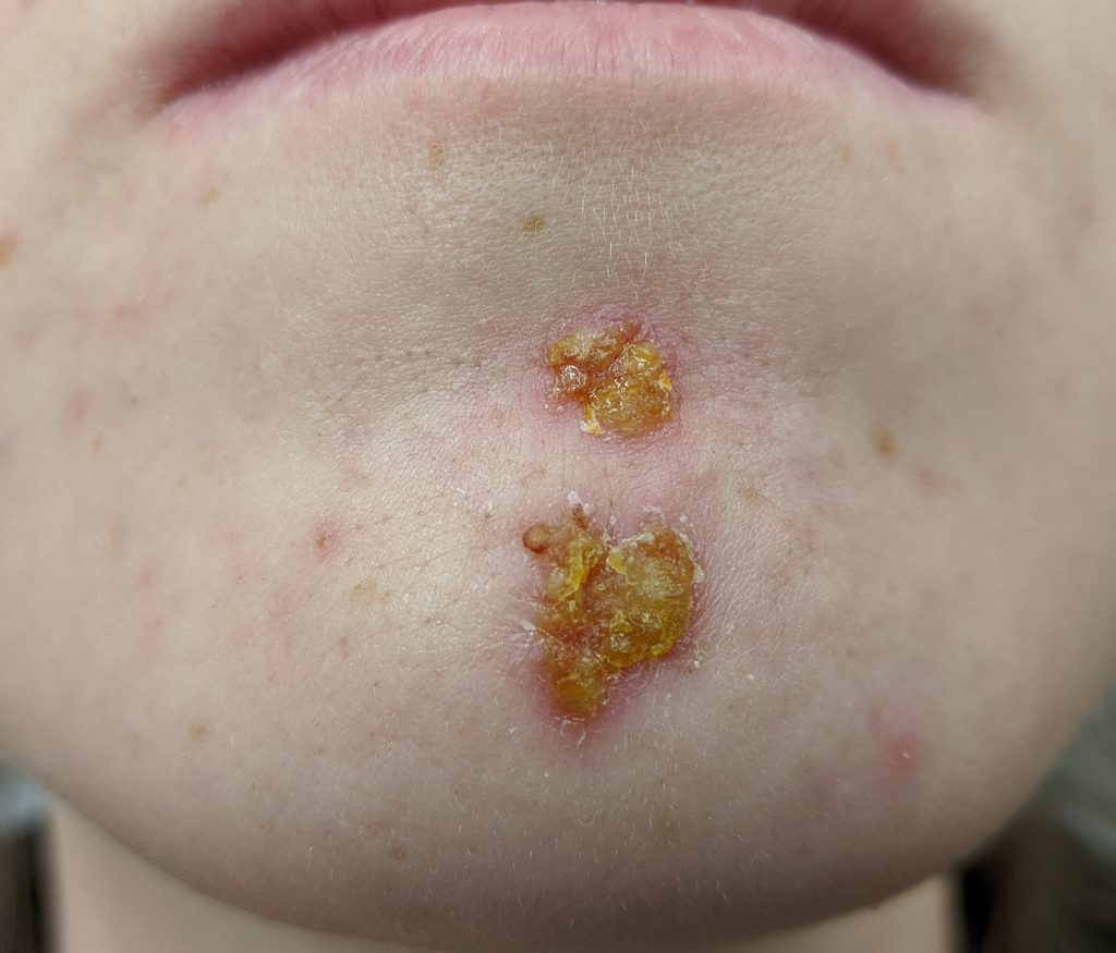 Figure 3.16. Impetigo