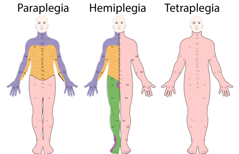 "Neurological_Levels_%26_Types_of_Paralysis.png" by Servier Medical Art is licensed under CC BY 2.0 Illustration showing Paraplegia, Hemiplegia, and Tetraplegia (Quadriplegia) in three human figures