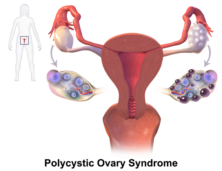 Illustration showing location of P C O S within female figure and closeup to show location on female reproductive organs