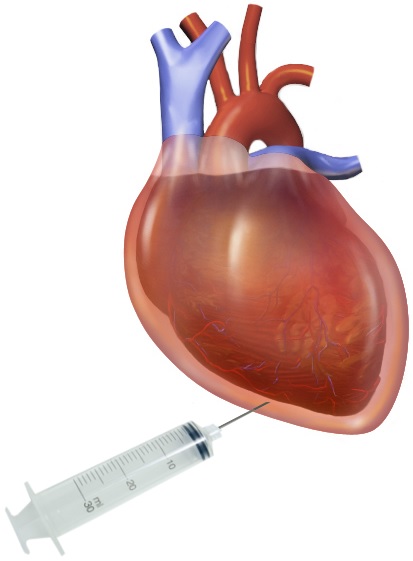 Illustration showing Pericardiocentesis