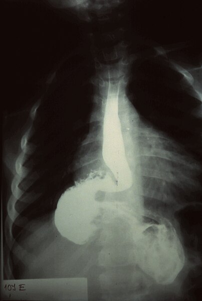 Image showing Upper GI Series for a Hernia and Obstruction