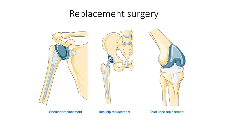 "Replacement_surgery_-_Shoulder_total_hip_and_total_knee_replacement_--_Smart-Servier.jpg" by Laboratoires Servier is licensed under CC BY-SA 3.0 Illustration showing different joint replacement surgeries