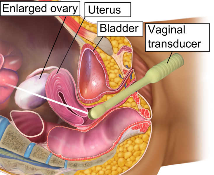 "Vaginal_ultrasonography_in_OHSS_-_coronal.png" by BruceBlaus CC BY 3.0 Image showing a transvaginal ultrasound, with labels