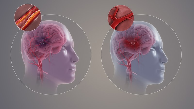 "Types_of_Stroke.jpg" by https://www.scientificanimations.com/ is licensed under CC BY-SA 4.0 Image showing a Comparison of Ischemia and Hemorrhagic Strokes
