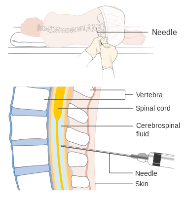 "Diagram_showing_how_you_have_a_lumbar_puncture_CRUK_157.svg" by Cancer Research UK is licensed under CC BY-SA 4.0 Image showing a lumbar puncture with closeup labeled for major parts