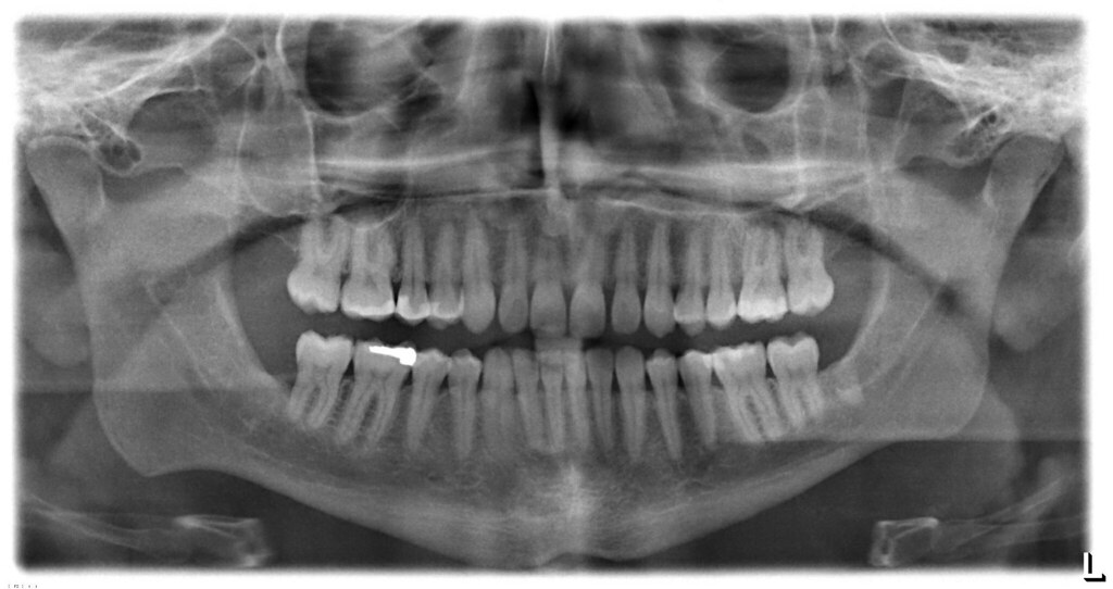 Image of a person's jaw and teeth using x-ray