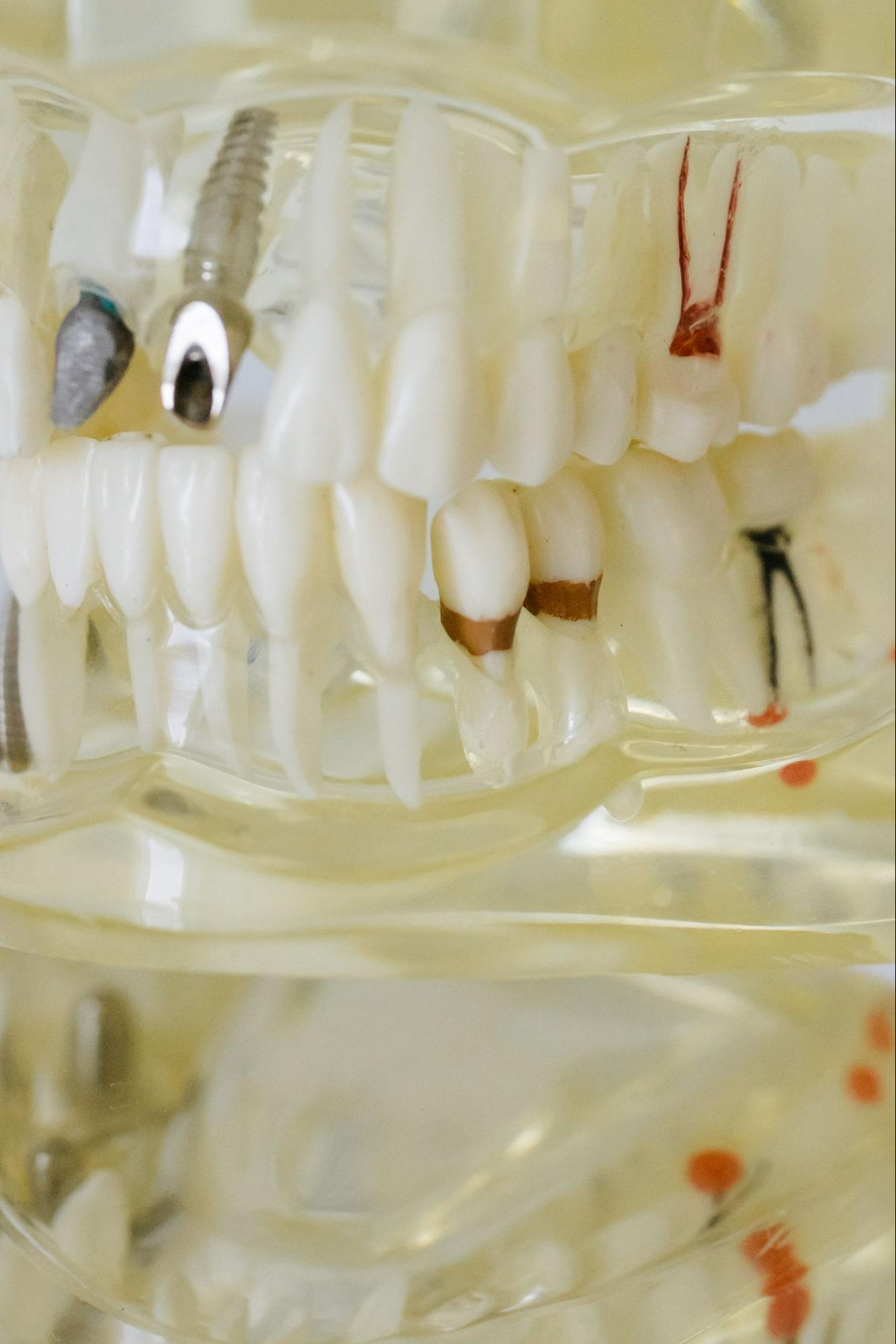 Image of a model of the teeth with various dental appliances in place