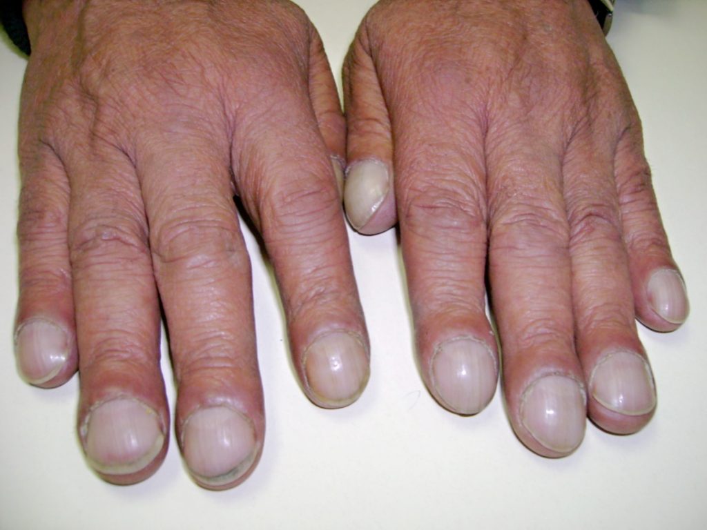 Photo showing clubbing on fingertips