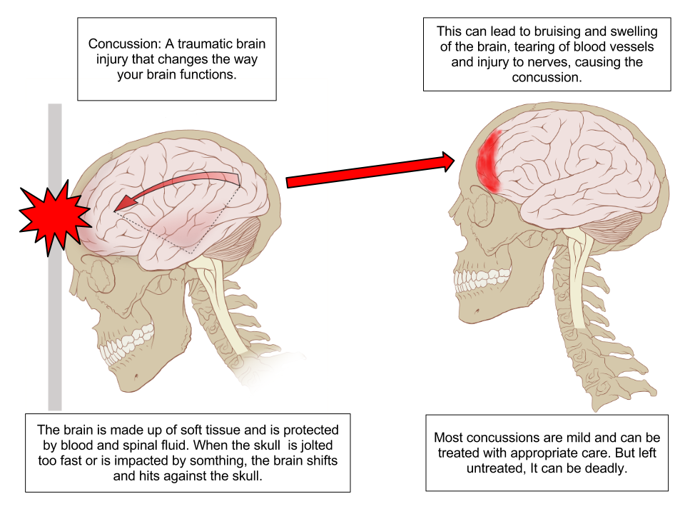 Migraine: MedlinePlus Medical Encyclopedia