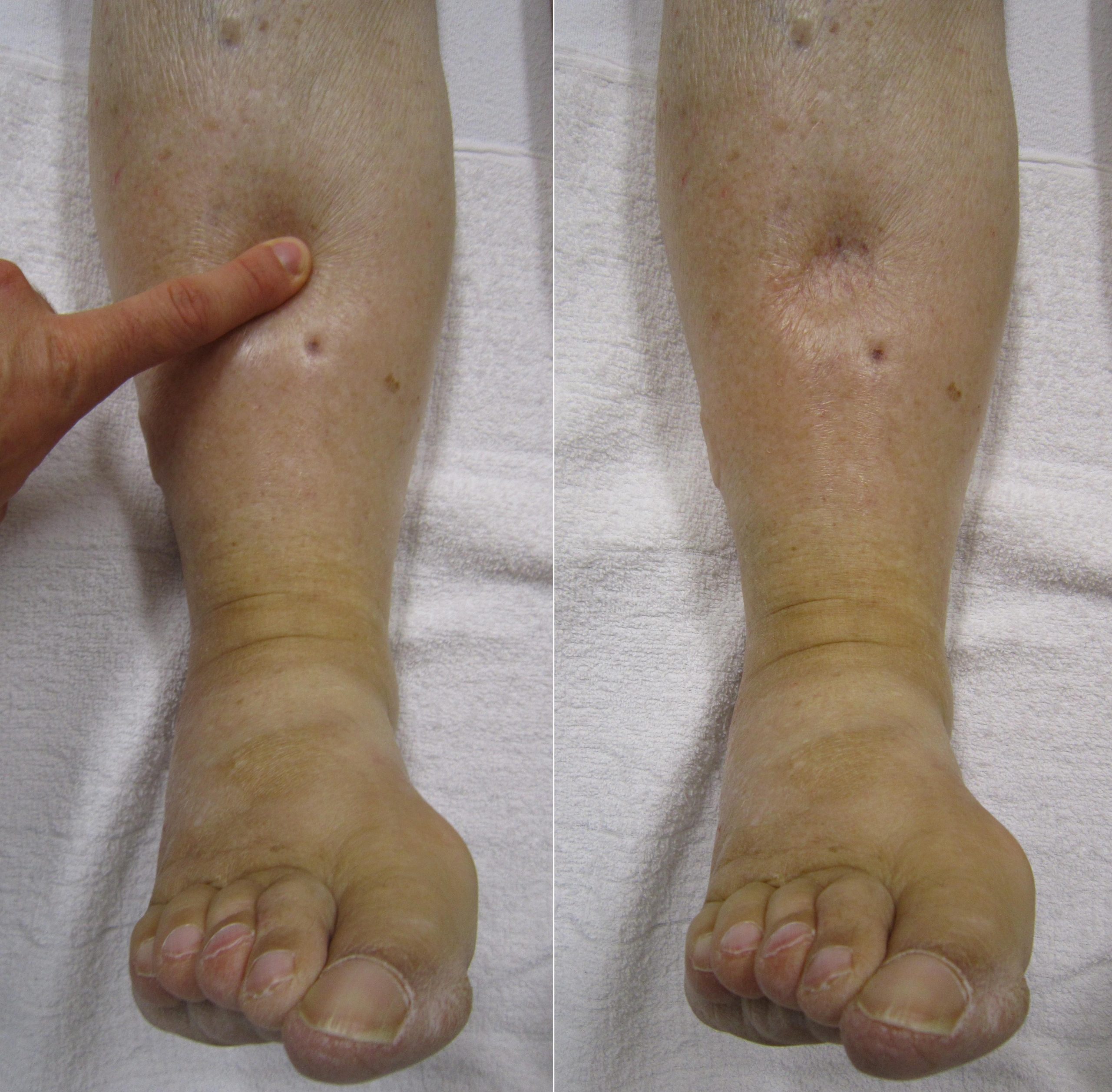 Photo showing a finger pressing into a patient's leg to assess for edema