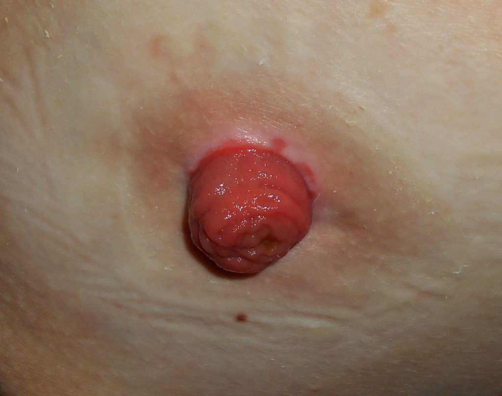 Photo showing closeup of a ileostomy stoma