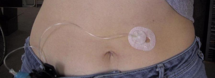 Photo of in insulin pump placed on an abdomen