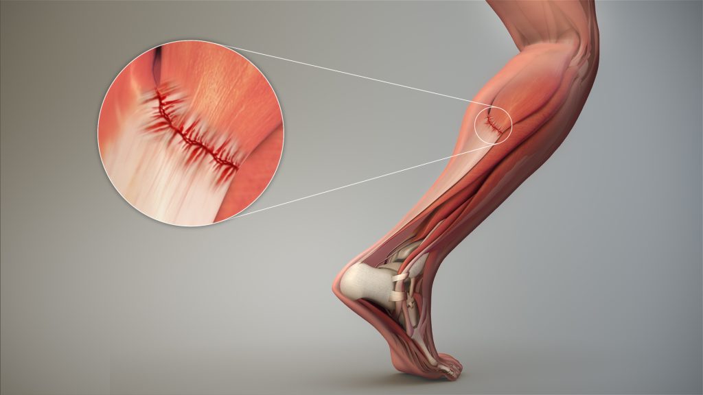 Image showing closeup of a strained tendon in the calf muscle