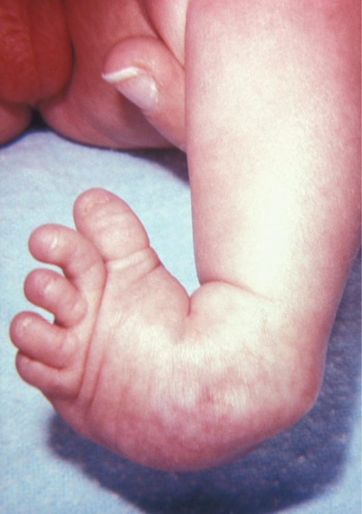 Photo showing closeup of clubfoot in an infant