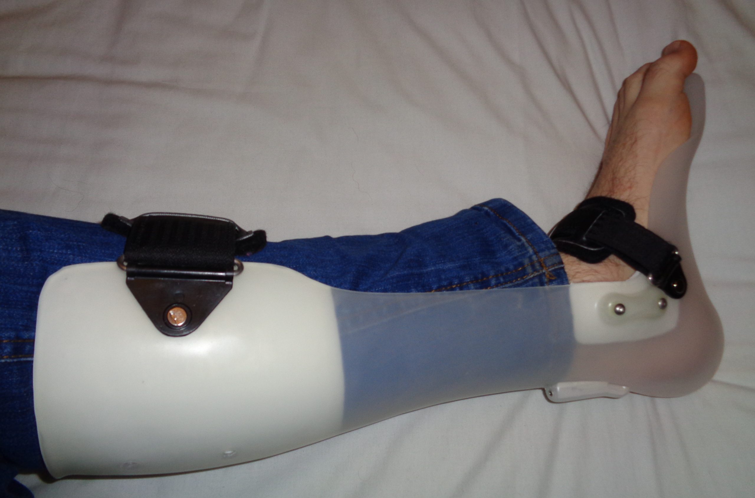 Photo showing brace being worn for foot drop