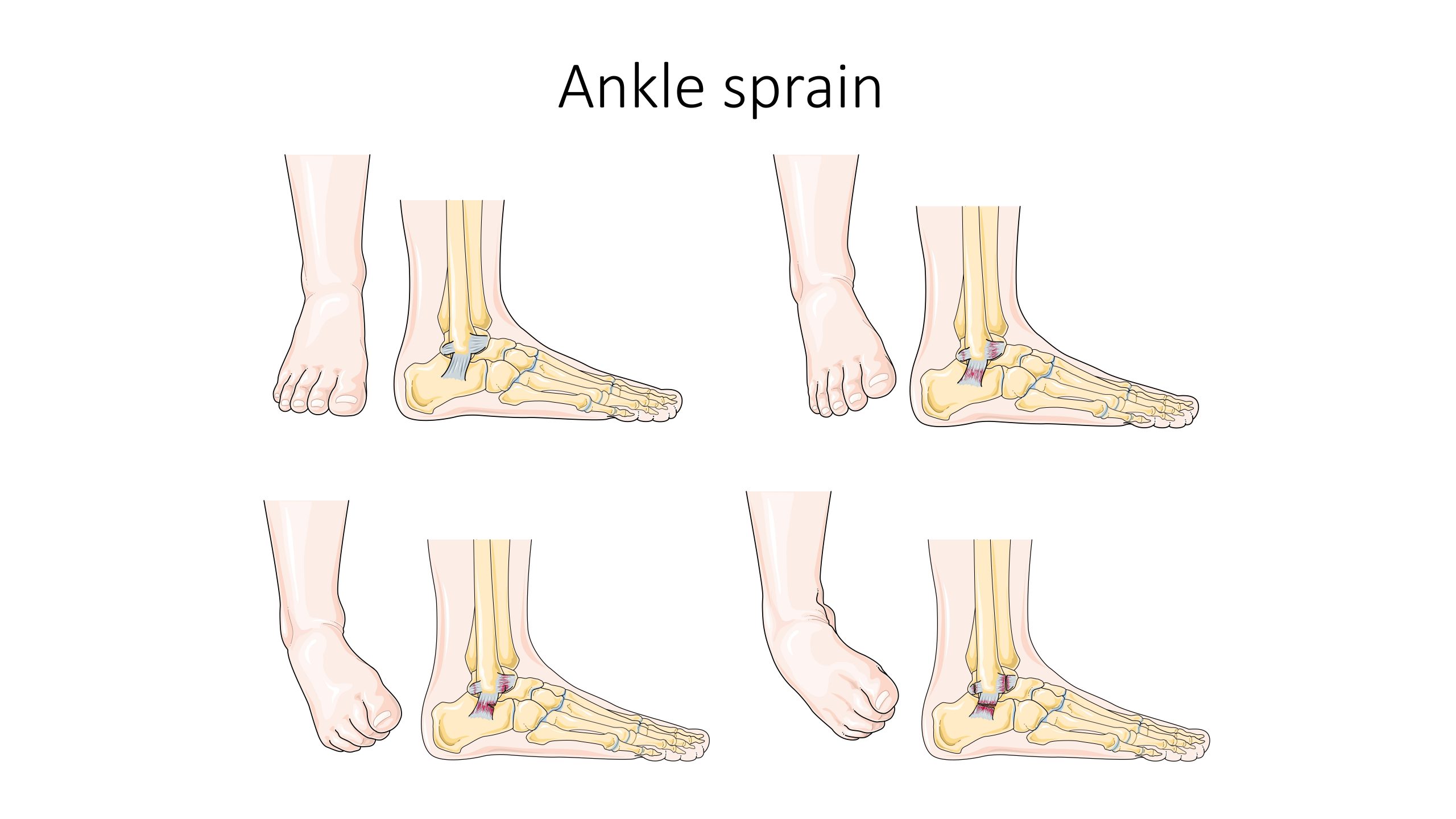 Illustration showing ligaments affected by an ankle sprain