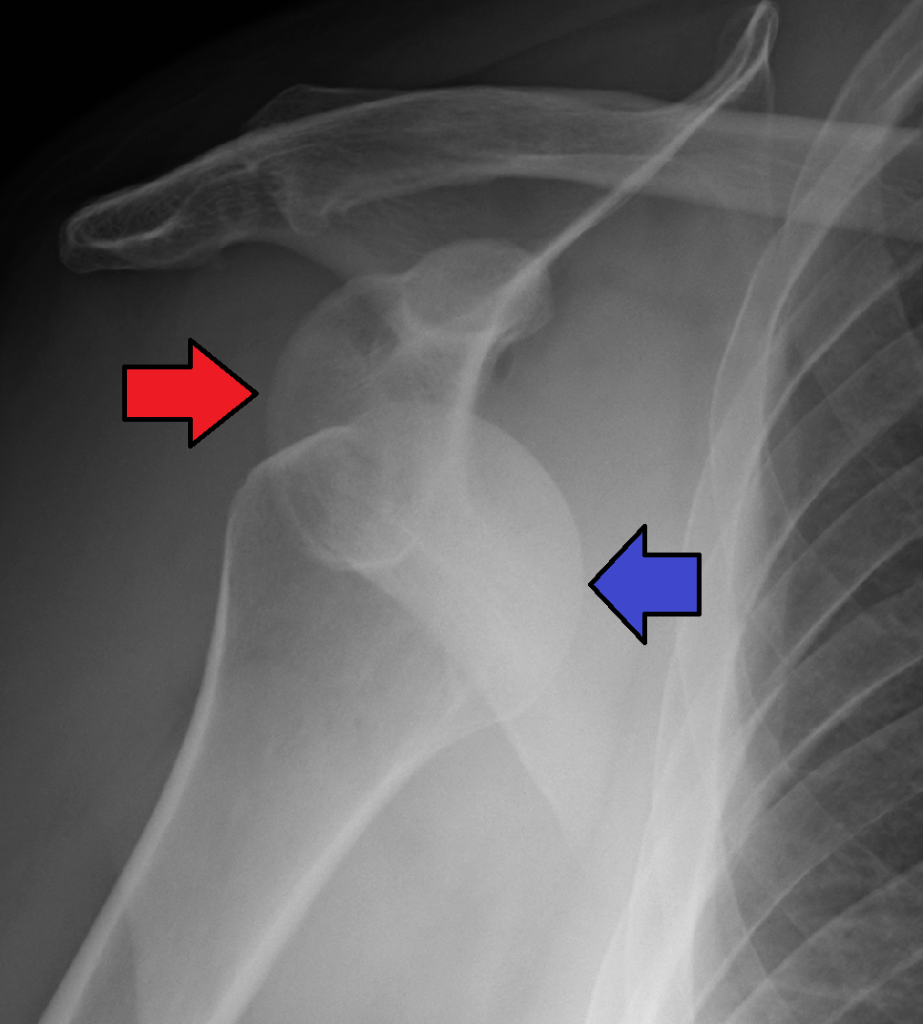 X-ray image, with arrows, showing dislocated shoulder