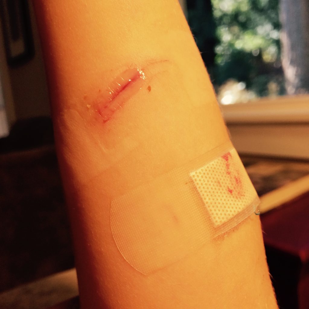 Photo showing Dermanbond on a healing wound