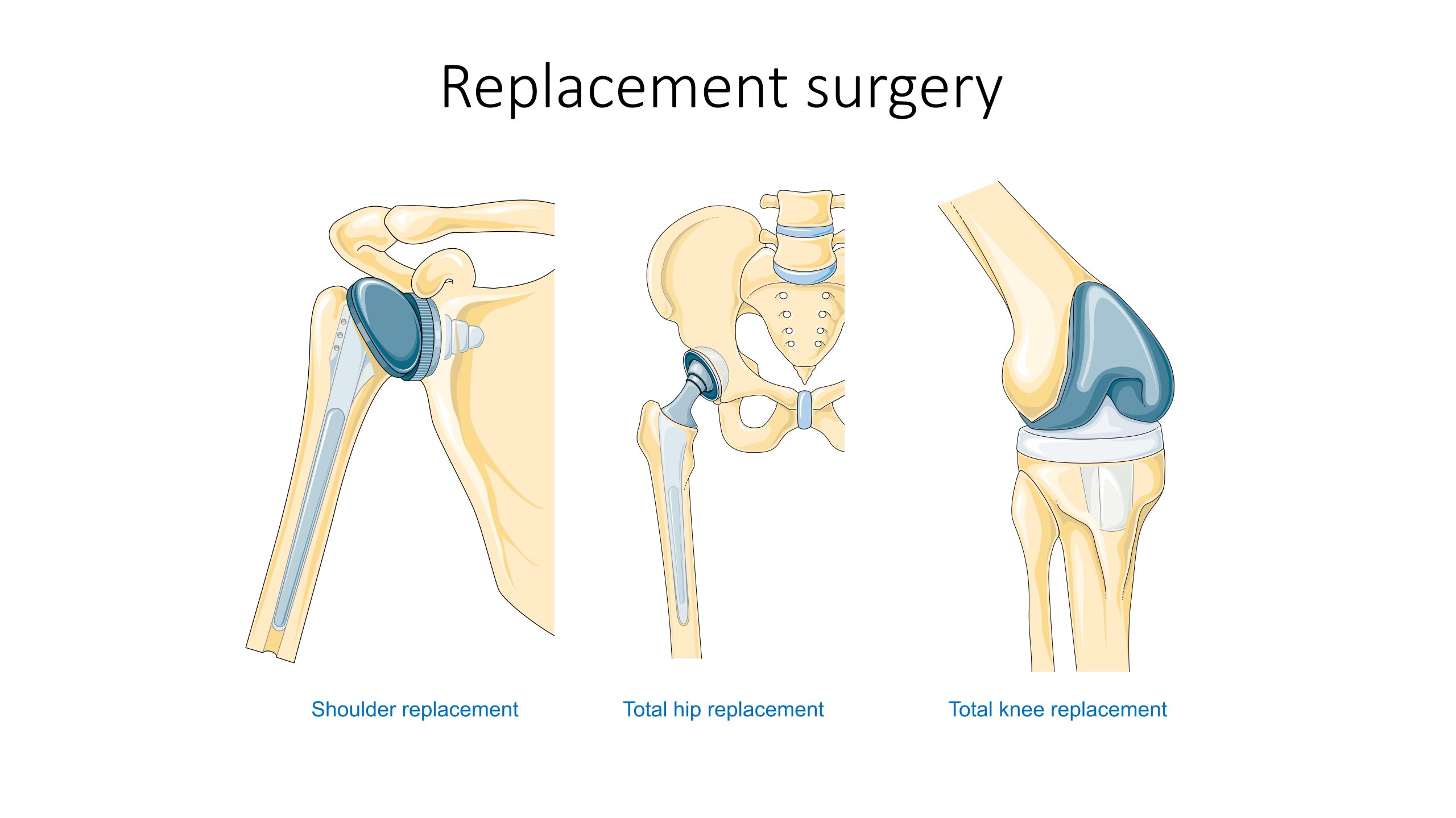 Illustration showing shoulder, hip, and knee replacements
