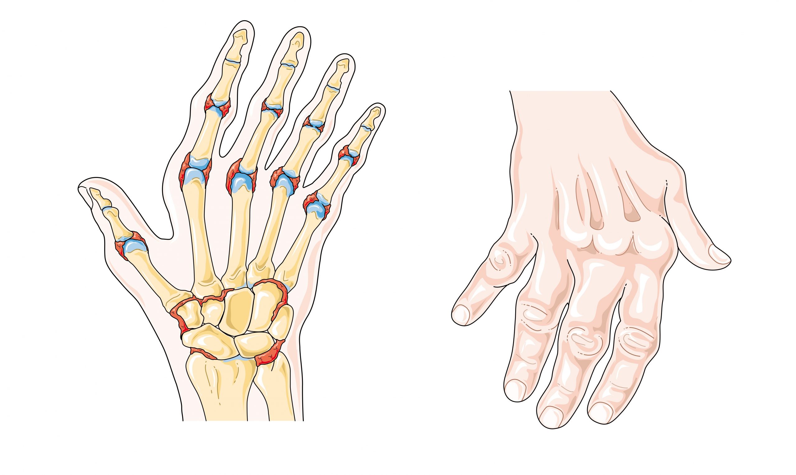Illustration showing hands with rheumatoid arthritis