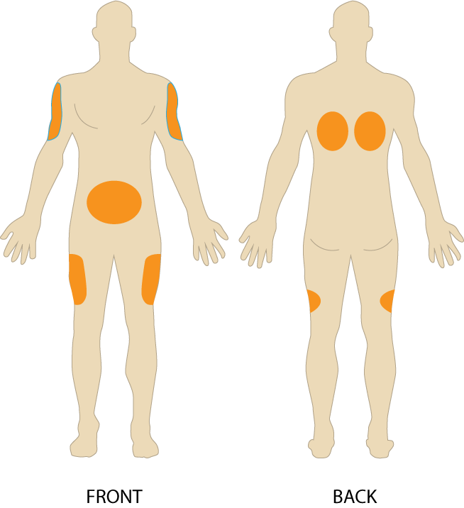 Illustration showing subcutaneous injection sites