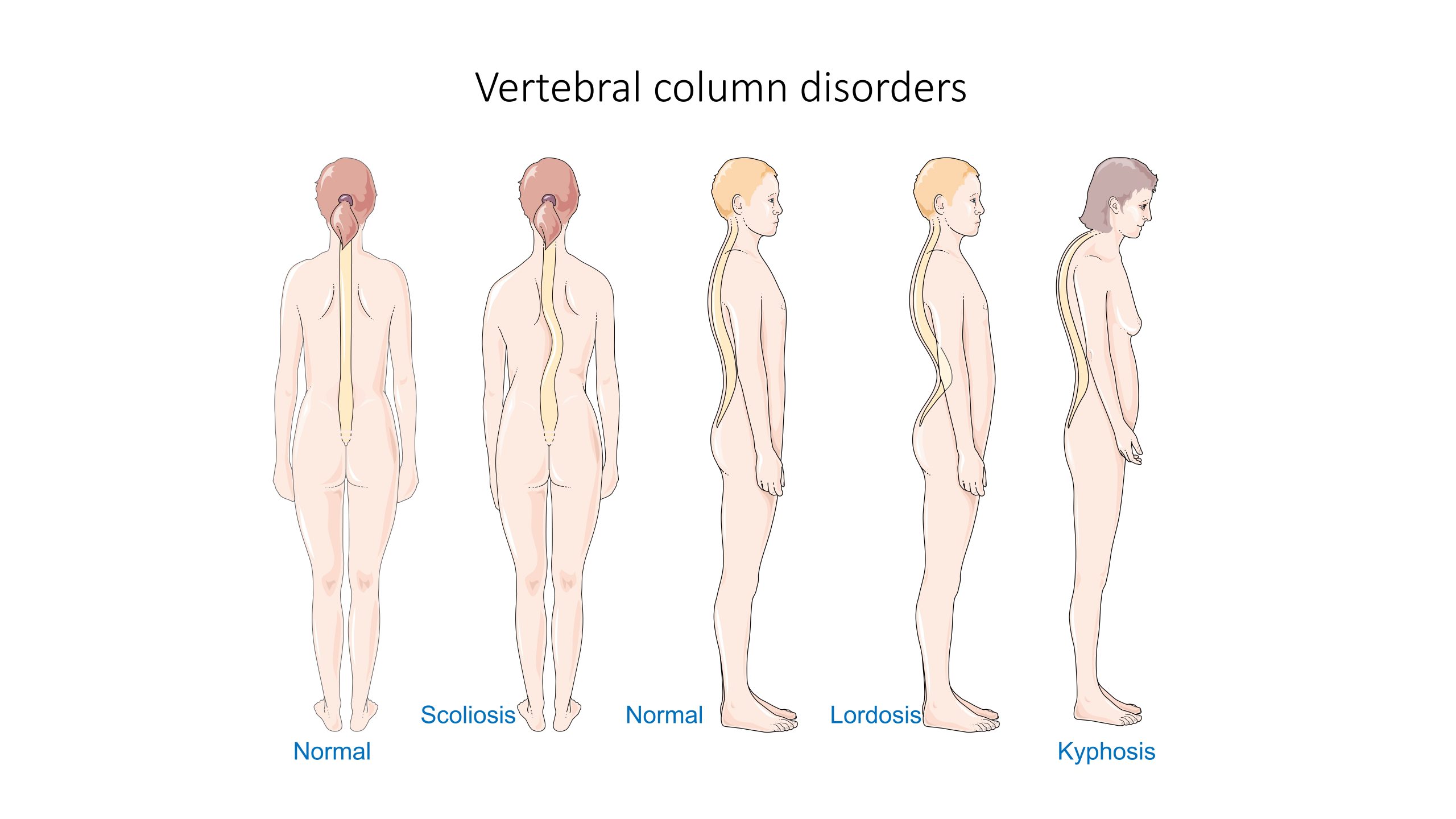 Illustration showing vertebral column disorders from rear and side views