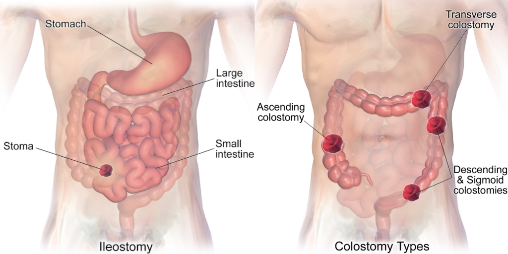 Illustration showing Location of an Ileostomy Compared to Colostomies